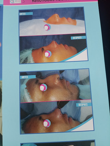 Rinoplastia Lima riplas